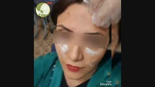 بوتاکس