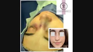 فیلم جراحی بینی گوشتی