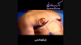 انیمیشن ژنیکوماستی | دکتر رضا رفیع