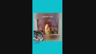 فیلمی جالب از کیست کلوئیدی