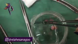 هیستروسکوپی و نمونه های گرفته شده از پولیپ