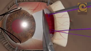 فیلم جراحی انحراف چشم (تکنیک رزکشن)