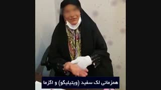 درمان بیماری ویتیلیگو  و اگزما