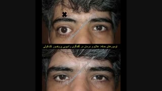 گفتگوی رادیویی پروفسور کشکولی درباره تومورهای حدقه | جراح پلک تهران