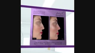 نمونه کار های جراحی بینی دکتر رضا رفیع