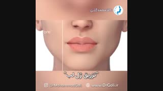 انیمیشن تزریق ژل لب