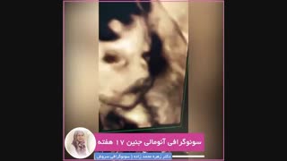 سونوگرافی آنومالی