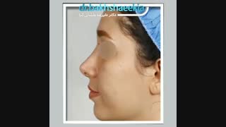 جراحی بینی بعد از چهار ماه