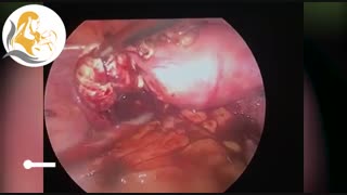 لاپاراسکوپی کیست دوطرفه اندومتریوز تخمدان