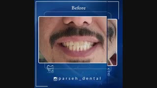 ونیزکامپوزیت فک بالا در دندانپزشکی پارسه