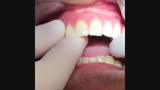 اوردنچر-پروتز فک بالا بر پایه ایمپلنت با اوردنچر