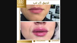 فیلم تزریق ژل لب در کلینیک دکتر کمالی
