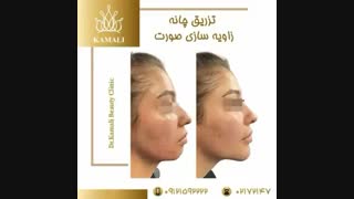 فیلم تزریق چانه و زاویه سازی صورت در کلینیک دکتر کمالی
