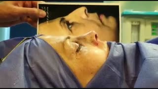 عمل زیبایی بینی با انحراف شدید توسط دکتر امید ابراهیمی بهترین جراح بینی در تهران