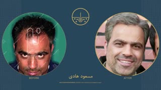 مسعود هادی قبل و بعد از کاشت مو در کلینیک دکتر نیلفروش زاده بلیچینگ دندان
