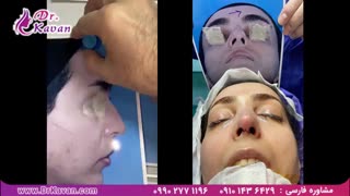 عمل بینی گوشتی توسط دکتر کاوان