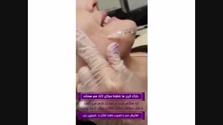 فیلم واقعی از بین بردن خطوط خنده