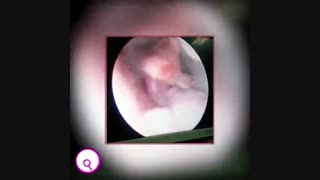 اگر بعد از یائسگی لکه بینی دارید، این فیلم را حتماً ببینید