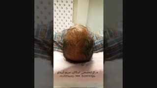 کاربردهای تکنیک شبیه سازی مو با میکروپیگمنتیشن