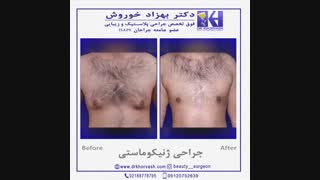 نمونه کار ژنیکوماستی