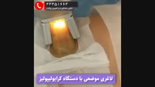 کرایو لیپولیز 6