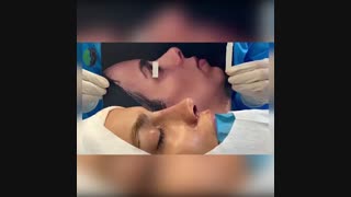 جراحی ترمیمی بینی در بینی کوتاه با روش ابداعی دکتر باستانی نژاد | جراح بینی تهران