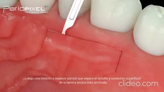 مراحل پیوند لثه