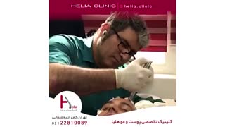 کاشت مو به روش میکروگرافت | کلینیک هلیا | 02122810089 | شماره 69