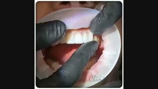 اصلاح طرح لبخند با استفاده از 10 واحد لمینیت سرامیکی | کلینیک دندانپزشکی ایده آل