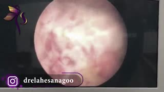 هیستروسکوپی پس از بارداری از دست رفته