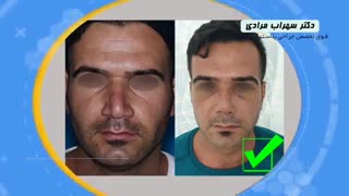 فیلم عمل بینی طبیعی مردانه