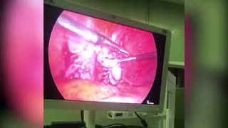 لاپاراسکوپی هیدروسالپنکس لوله چپ