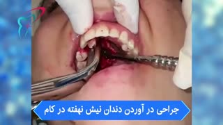 جراحی درآوردن دندان نیش نهفته در کام