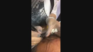 میکرو اسکالپ |  اسکالپ |  تاتو سر