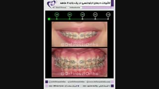 تاثیرات درمان ارتودنسی | دکتر فاضل فیروزی