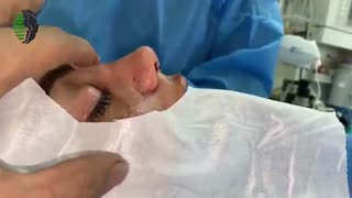 جراحی بینی به فرم پرانتزی با پوست ضخیم | دکتر باستانی نژاد