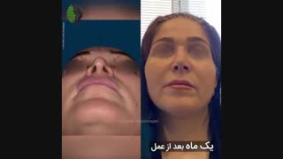 یکماه بعد از جراحی بینی ترمیمی | دکتر باستانی نژاد | جراح بینی