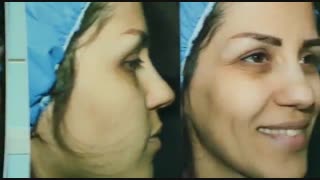جراحی بینی گوشتی | دکتر امید ابراهیمی لیزر صورت