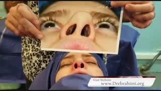 عمل ترمیمی اصلاح کجی بینی | دکتر امید ابراهیمی جراح بینی تهران