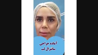 فیلم نتیجه سانترال لب 10 روز پس از جراحی (بلافاصله بعد از کشیدن بخیه)