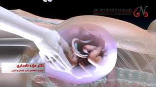 روش زایمان سزارین