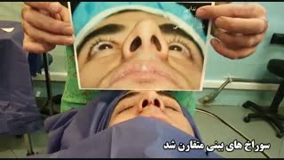 عمل بینی استخوانی توسط دکتر امید ابراهیمی جراحی لثه