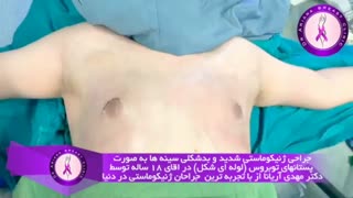 جراحی ژنیکوماستی شدید در آقای 18 ساله
