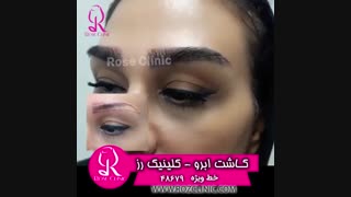 فیلم کاشت ابرو | کلینیک رز | 02148679 | شماره 218