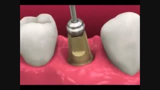 روکش ایمپلنت و روش قالبگیری