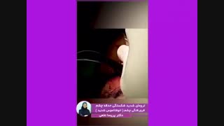 فیلم واقعی جراحی ترومای شدید شکستگی حدقه چشم