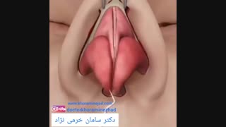 فیلم جراحی زیبایی بینی به روش باز