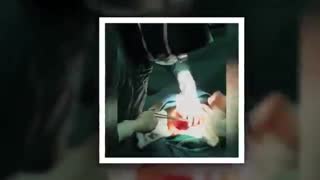 فیلم سزارین 4 قلو ها در اهواز توسط دکتر مهناز احمدی منافذ باز پوست