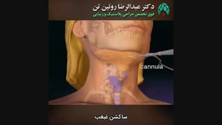 ساکشن غبغب | فوق تخصص جراحی پلاستیک | دکتر عبدالرضا روئین تن