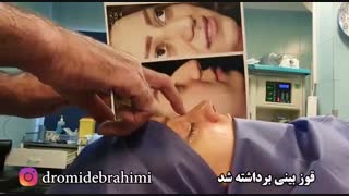 عمل بینی گوشتی توسط دکتر امید ابراهیمی عمل زیبایی